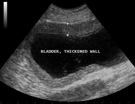 Ultrasound Of Cystitis Theayurveda