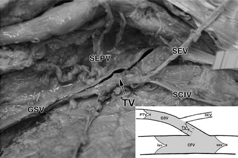 Figure 1 From Venous Valves And Major Superficial Tributary Veins Near