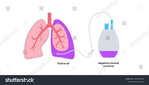 Tunneled Pleural Catheter System Ambulatory Pleural Stock Vector ...