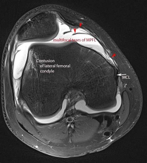 Mri Newsletter Patella Dislocation Radius Imaging