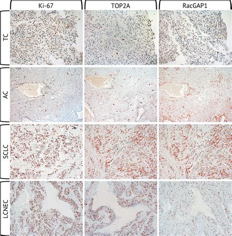 Immunohistochemical Stainings Of Ki Top A And Racgap