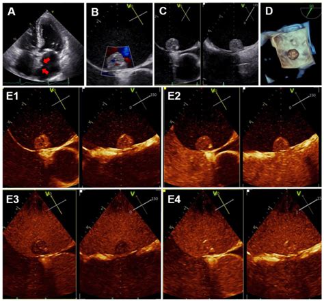 Contrast Enhanced Ultrasound For Non Invasive Differential Diagnosis Of