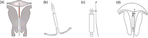 Intrauterine Devices A Structural Diagram Of A Frameless Fixed