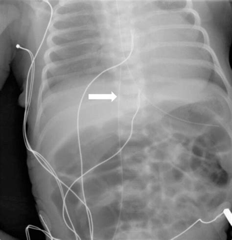 Postoperative Radiograph Demonstrating The Radio Opaque Epidural