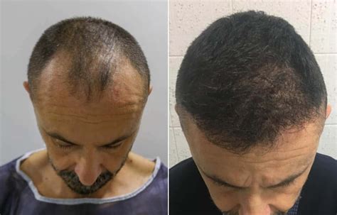 Before And After Hair Transplant Step By Step Situation Rephair