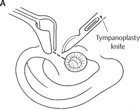 Stapedotomy and Stapedectomy | Ento Key