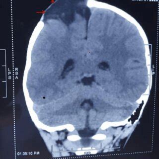 A Plain Computed Tomography Scan Of The Brain Showing The Defect In The