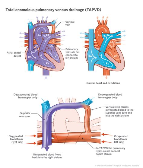 Cardiology Total Anomalous Pulmonary Venous Drainage