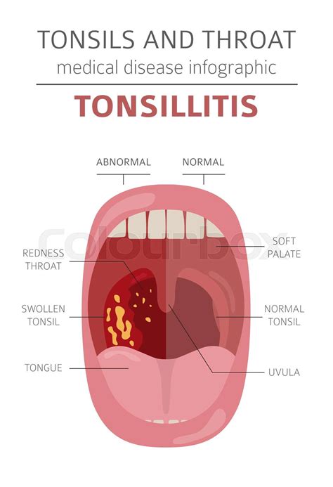 Tonsils and throat diseases. Tonsillitis symptoms, treatment icon set. Medical infographic ...