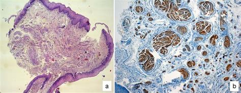 Traumatic Neuroma Of The Anus After Milligan Morgan Hemorrhoidectomy