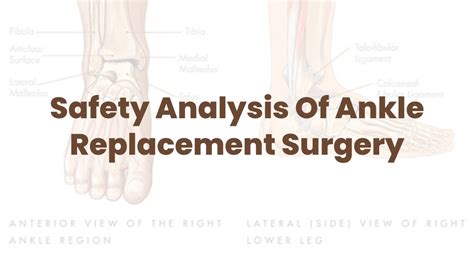 Safety Analysis Of Ankle Replacement Surgery Mufameditourism