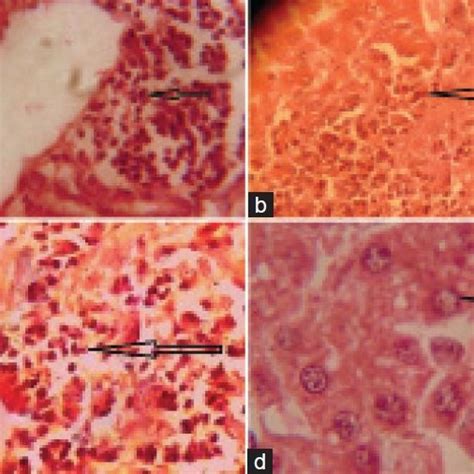 A Microphotograph Showing Infiltration Of Mononuclear Cells Around