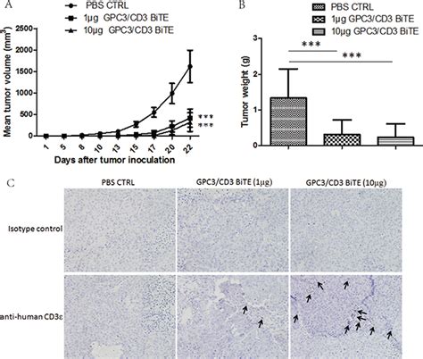 Treatment Of Hepatocellular Carcinoma With A Gpc3 Targeted Bispecific T