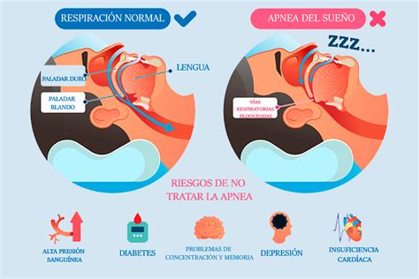 Apnea Del Sue O Cu Les Son Sus S Ntomas Y Tratamientos