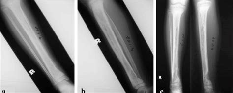 Case Anteroposterior A And Lateral B Plain Radiographs At