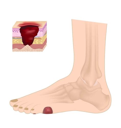 wound care vaporox treatment  foot ulcers louisville ky