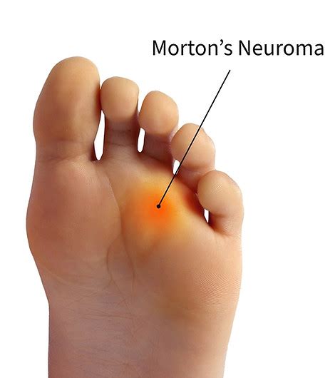 Morton S Neuroma Cortisone Injection Musculoskeletal Ultrasound And Injections