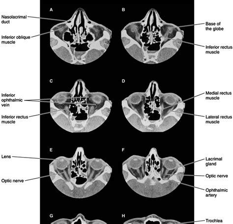 Human Anatomy: Orbit CT scan Anatomy