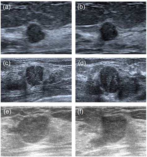 Figure 1 From Differentiation Between Phyllodes Tumors And Fibroadenomas Through Breast