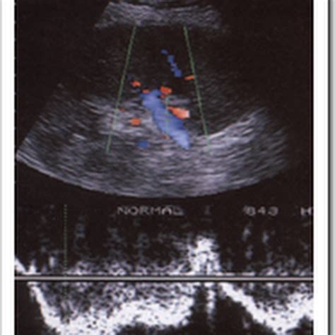 Ultrasound images of Pseudoaneurysms and arteriovenous fistulae ...