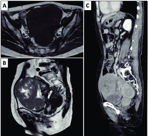 Imaging Findings T1 Weighted A And T2 Weighted B MRI The Tumor