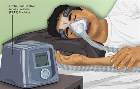 Mascarillas De Cpap Tama O Ideal Y Problmeas Dr Ferr M Dico Del