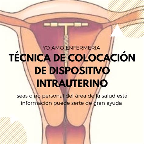 DISPOSITIVO INTRAUTERINO TÉCNICA DE COLOCACIÓN