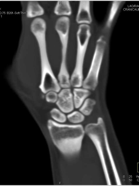 CT Carpal Bones Without a Fracture - Musculoskeletal Case Studies ...