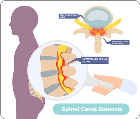 Spinal Canal Stenosis