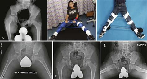 Legg-Calvé-Perthes Disease | Musculoskeletal Key