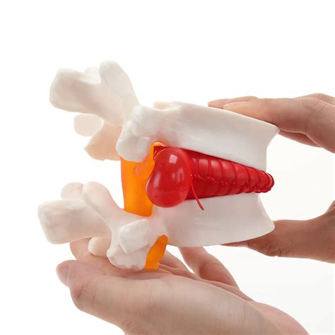 Buy Human Anatomical Lumbar Disc Herniation Model - Lumbar Spine Model