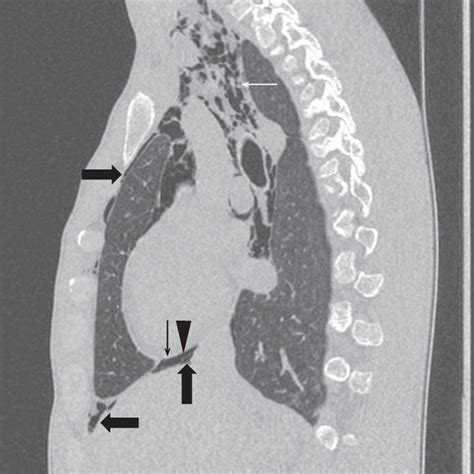 Chest X Ray A And Chest Ct B On Both Pictures Subcutaneous Download Scientific Diagram