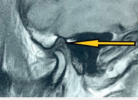 Post Surgical Mri Sagittal Section At Nine Months Followup Showing