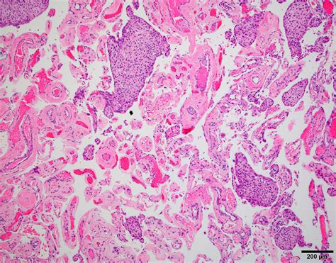 Meningioma Histology