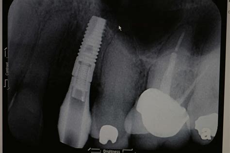 5 Axis Dental Design Center Scanning Jig For Itero Bone Level Implant