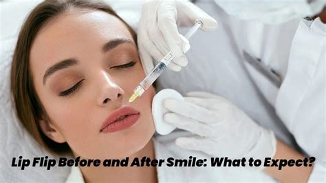 Lip Flip Before and After Smile - What to Expect?