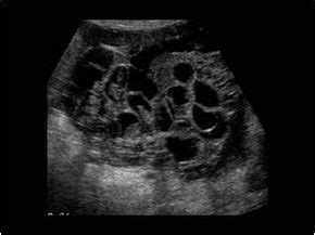 Septated Ovarian Cyst Ultrasound