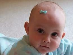 baby hair loss: Children's Hair Loss - Types of Hair Loss in Infants ...