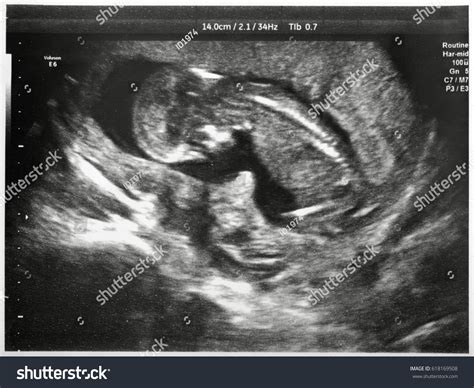 315 Ultrasound Third Trimester Images, Stock Photos & Vectors | Shutterstock