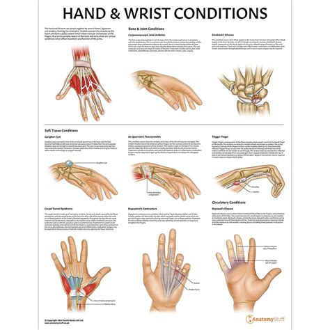 Hand And Wrist Conditions Poster Hands Fingers Pathology Chart