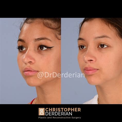 Cleft Rhinoplasty — Dr Derderian — Plastic And Reconstructive Surgery