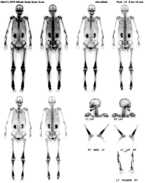 X Ray Of Left Femur Revealed Diffuse Osteosclerosis With Focal