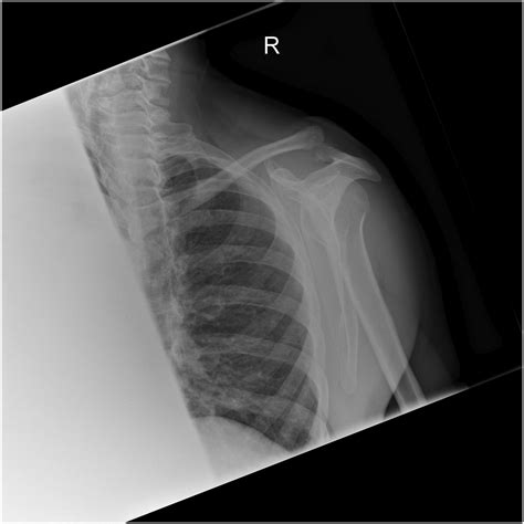 Concomitant Coracoid Base Fracture And Acromioclavicular Joint