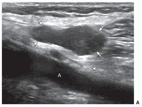 Liposarcoma Low Grade Myxoid Recurrent Ultrasound Image A Shows Hypoechoic Liposarcoma