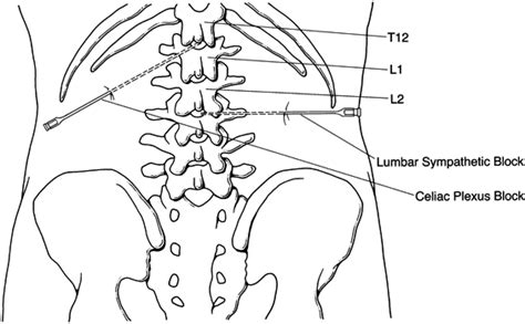 Lumbar Sympathetic Block - Pomona Pain Management Doctor | epidural ...