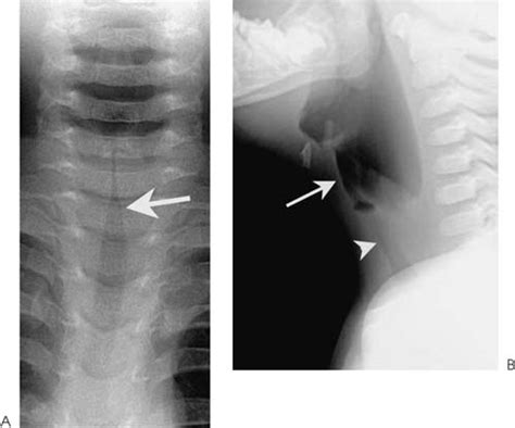 Laryngomalacia Xray