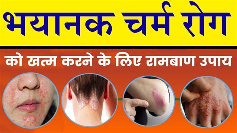 भयानक चर्म रोग को खत्म करने के लिए रामबाण उपाय Remedies For Skin Diseases Ayurvedic