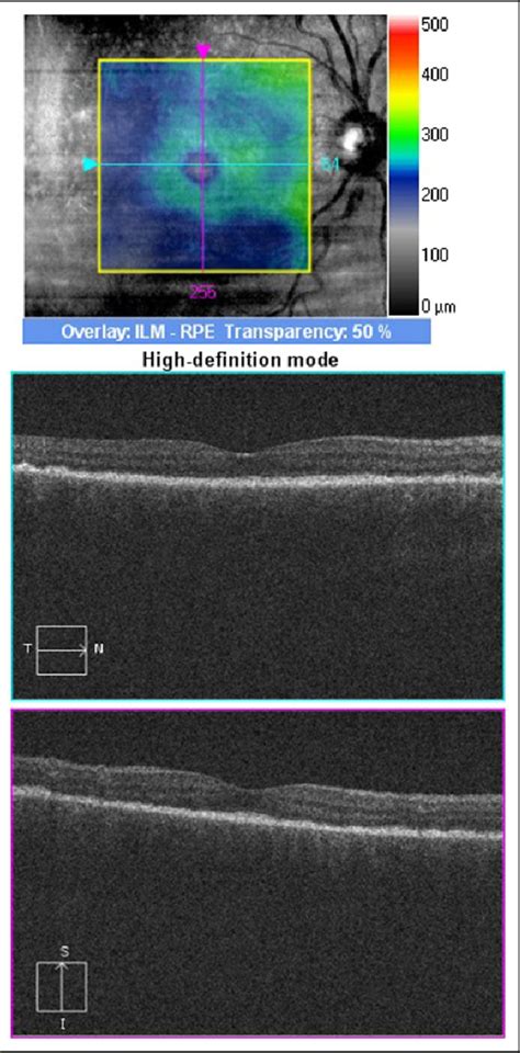 Figure 5 From Successful Treatment Of Bilateral Diffuse Uveal