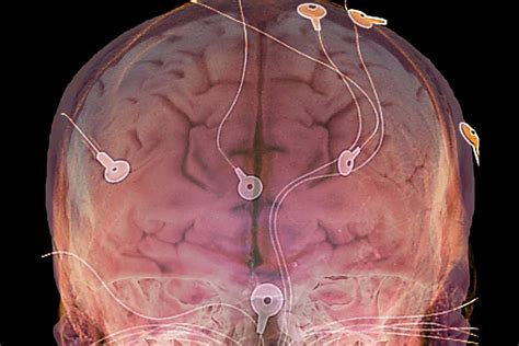 Brain Implants Electrical Stimulation Boosts Ability To Think Flexibly