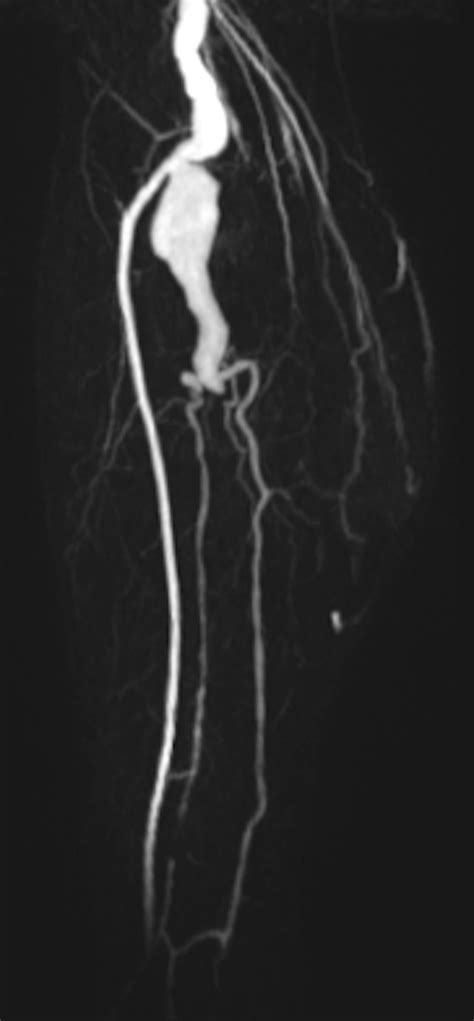 Tibioperoneal Trunk Aneurysm Resulting In Compartment Syndrome With